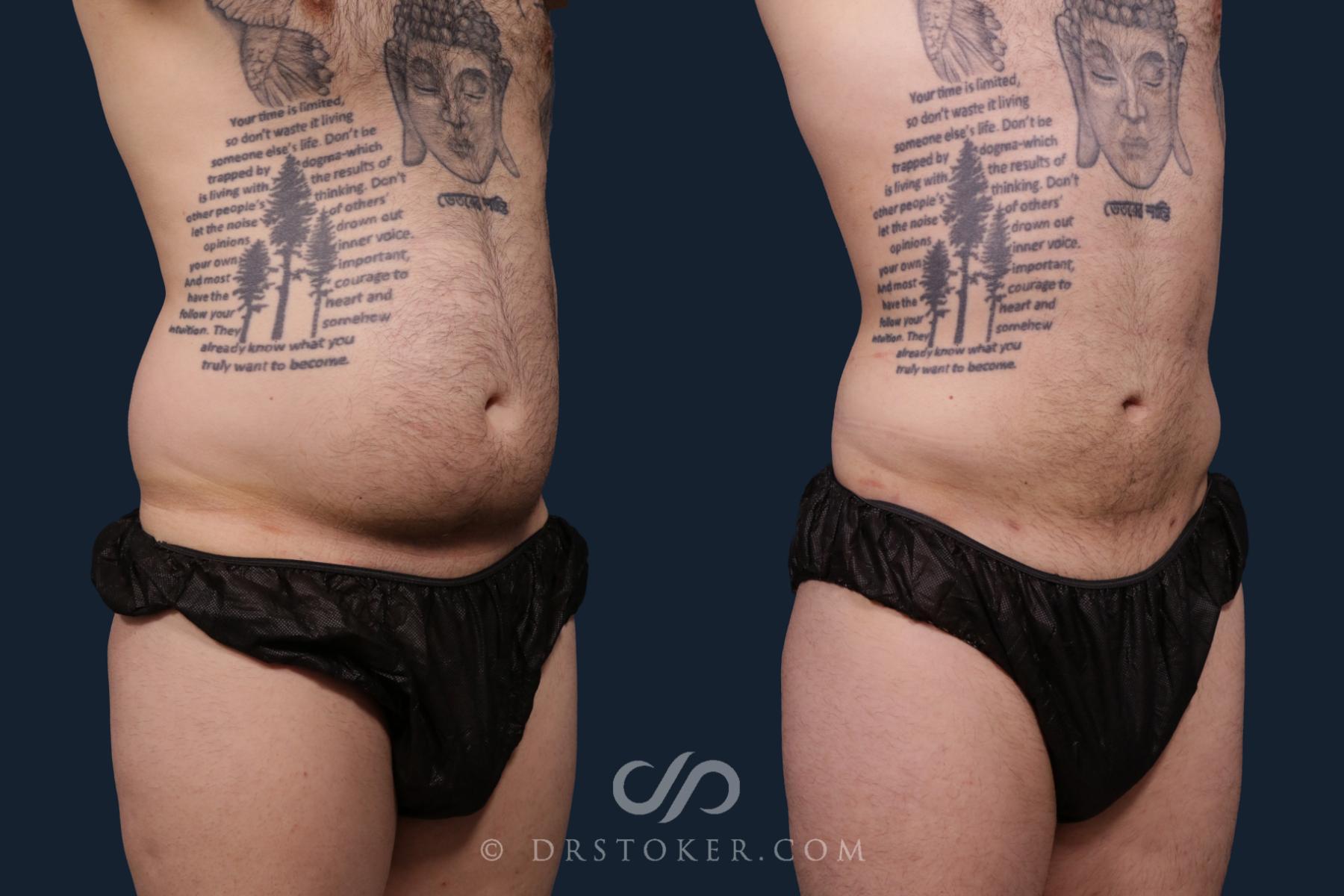 Liposuction Before and After Pictures Case 2197 | Los Angeles, CA ...